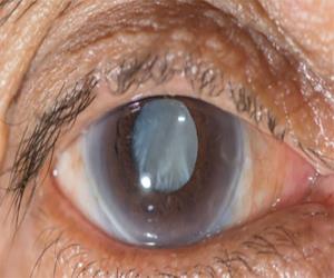 Cataract