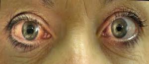 GLAUCOMA